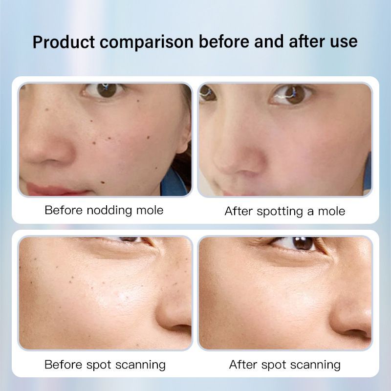 Dotting Mole Pen Nevus Removal Tool Spot Remover Red Blue Light Therapy Beauty - Image 4