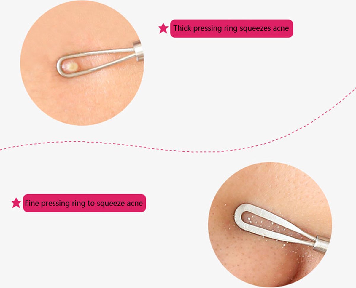 Comedone Spoon | Blackhead Remover | Acne Remover | Comedone Extractor | Blackhead Removal IRVS - Image 2