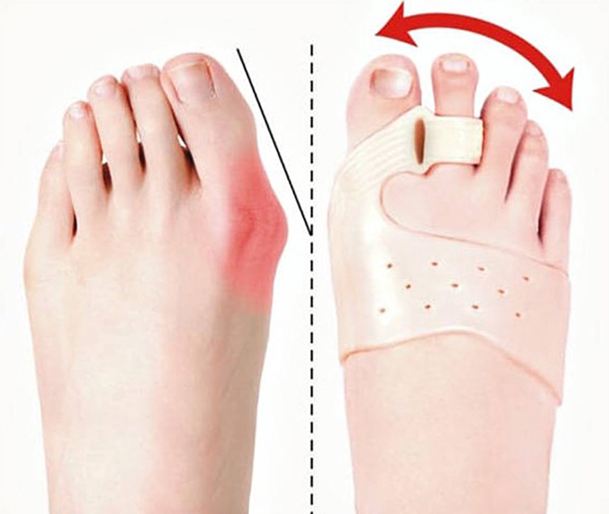 Toe spreader - Bunion toe corrector | bunion - Straighten toe - Bunion - Image 3
