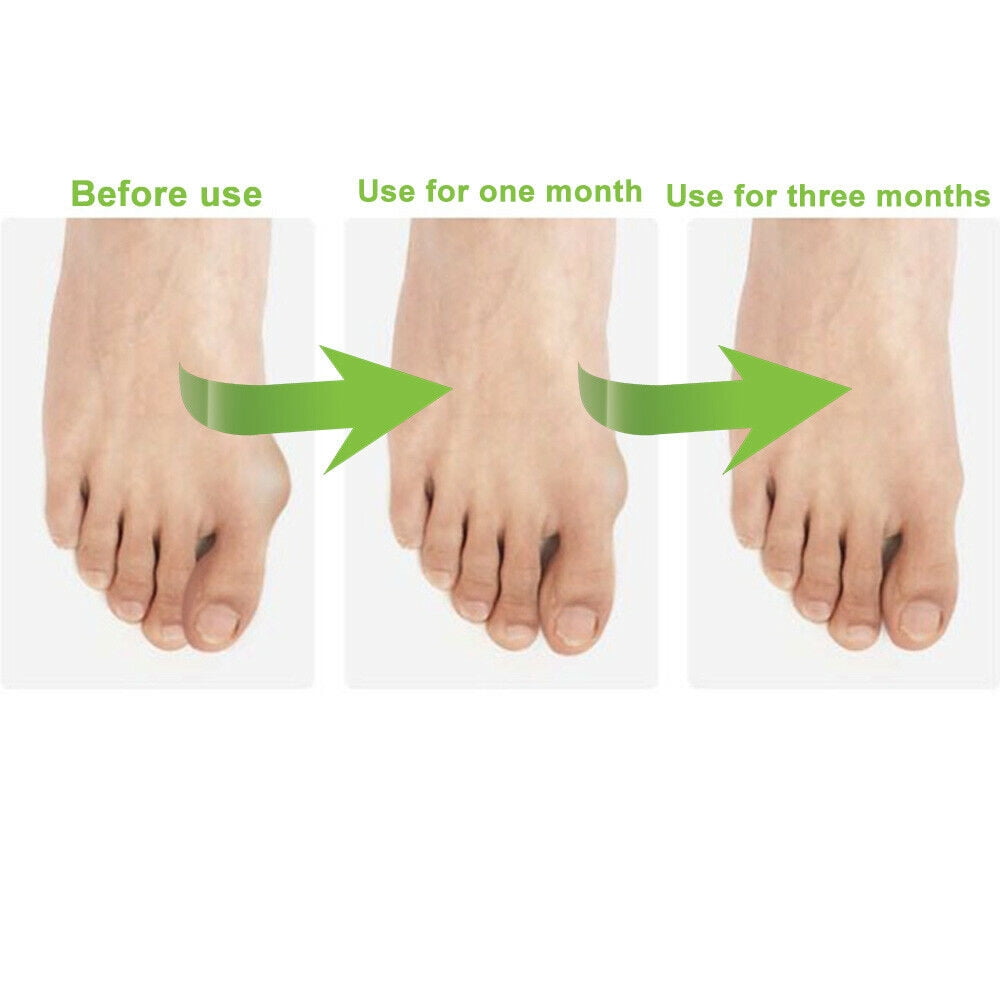 Onemayship Silicone Gel Toe Separator Orthotics Bunion Toes Spacer Pain Reliever 12Pcs - Image 2