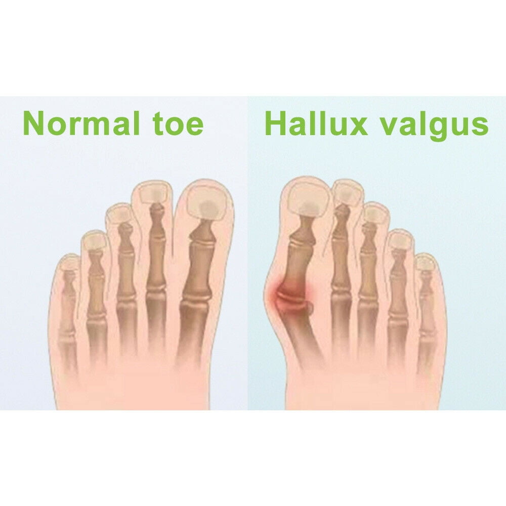Onemayship Silicone Gel Toe Separator Orthotics Bunion Toes Spacer Pain Reliever 12Pcs - Image 3