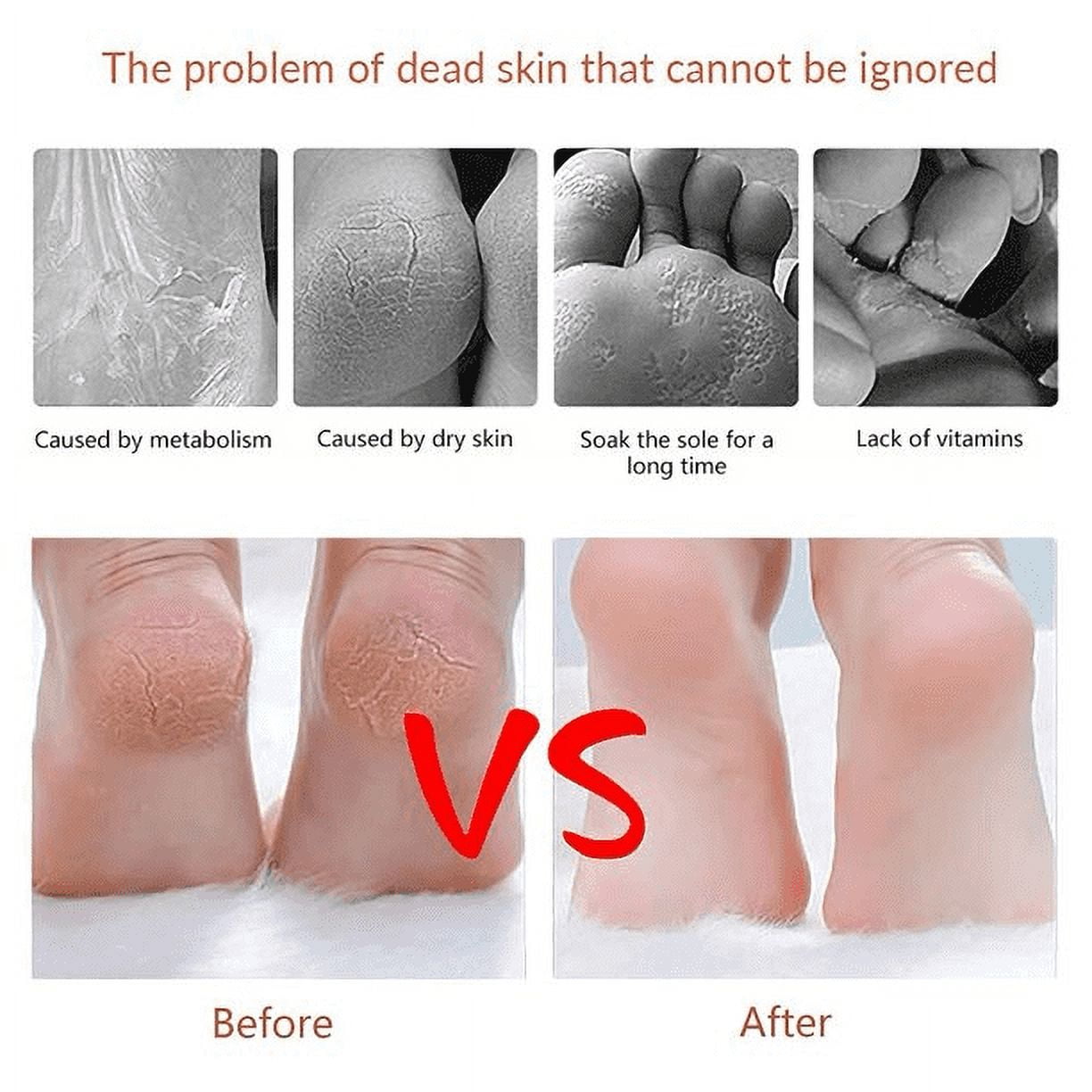 Tutuviw Foot Callus Shaver & Scraper Remover - Callous Removers for Feet Razor Tools with 10 Blades - Professional Pedicure Knife for Heel Hand Skin Care - Image 3