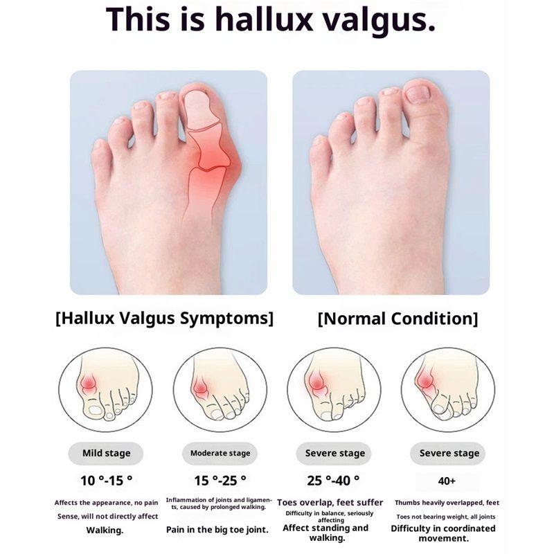 Bunion Relief Sleeves Bunion Pads Brace Cushions Toe Straightener Hallux Valgus Relief Kit Pack (small) - Image 4