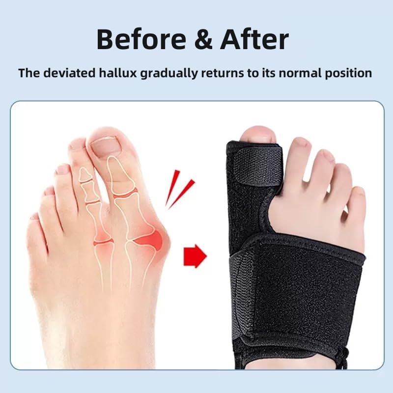 Recovist Bunion Brace - Adjustable Orthopedic Splint for Hallux Valgus Correction & Pain Relief, Day & Night Wear Support for Men & Women (2PC) - Image 3
