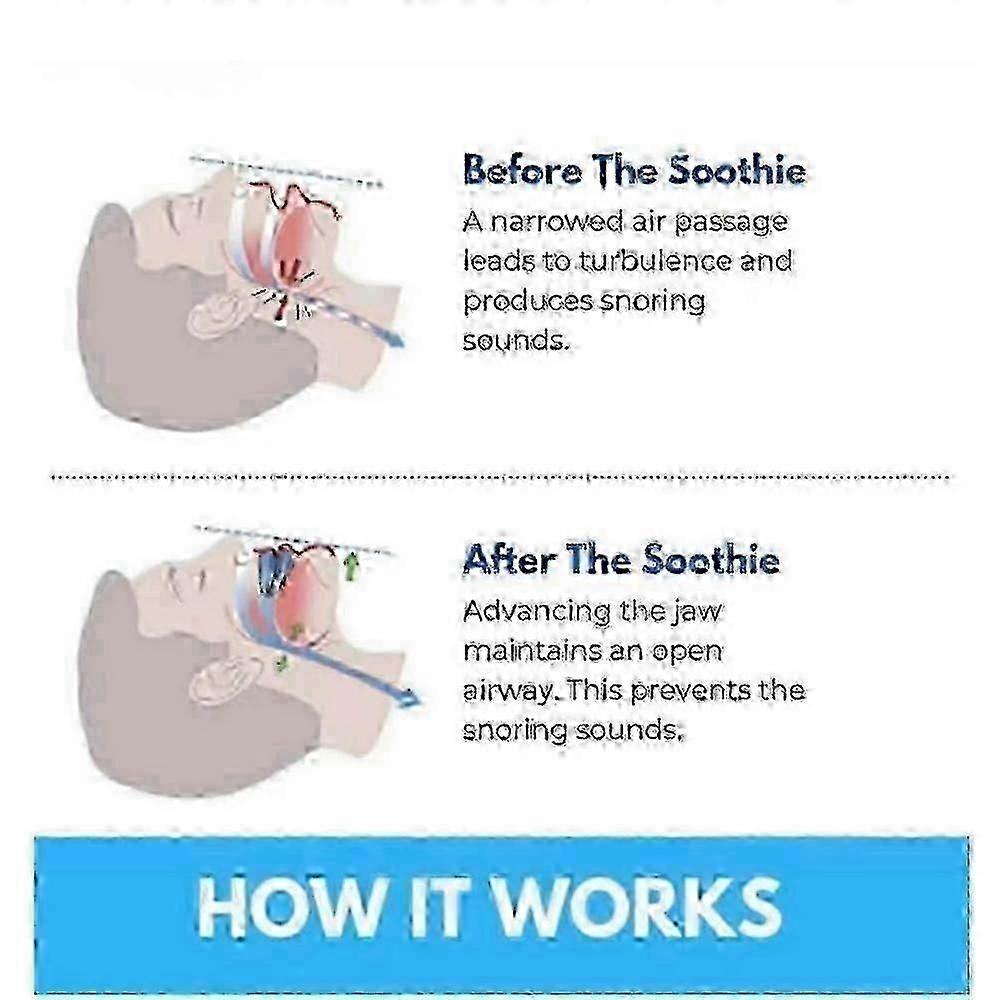Honex Anti-Snoring Mouthpiece - Quite Night Device, PC+EVA - Image 4