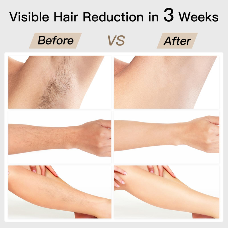 Laser Hair Removal, BoSidin IPL Hair Removal with Painless Ice-Cooling, 2-in-1 Face SR Rejuvenation, 6+1 Modes, 6 Levels Hair Removal for Women Permanent, Laser Hair Removal Kit with Shaver, Goggles - Image 6