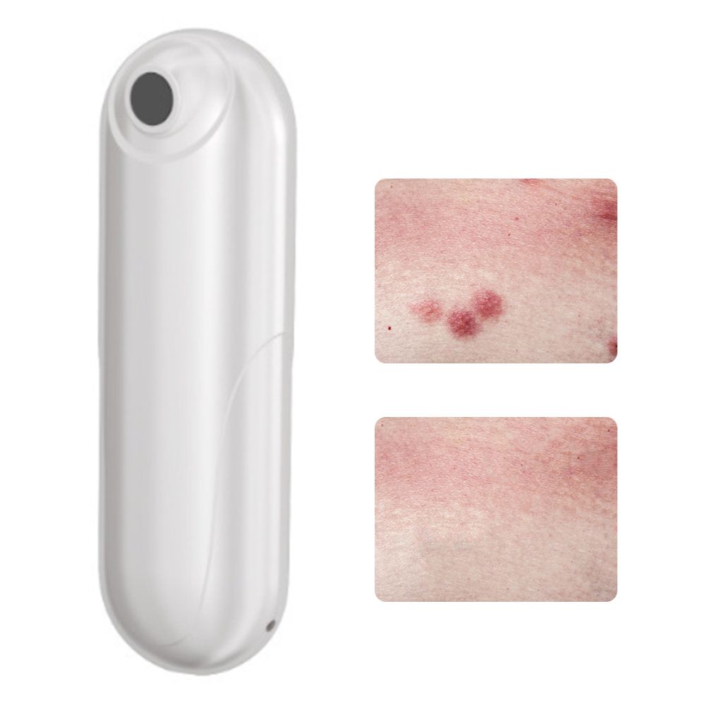 Bug Bite Itch Relief Tool USB Rechargeable Mosquito Bite Sucker Chemical Free for Bug Bites Bee Wasp Stings - Image 1