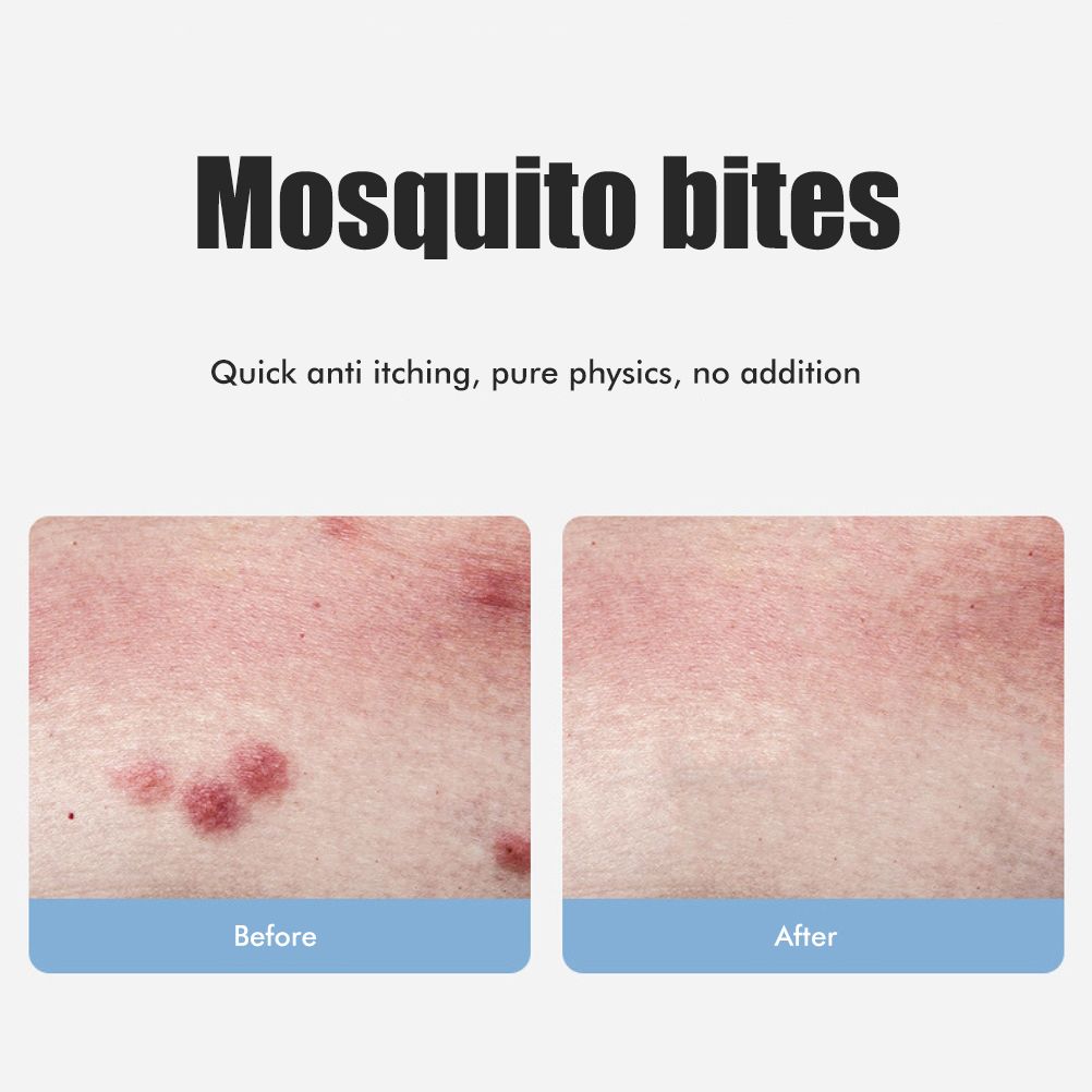 Bug Bite Itch Relief Tool USB Rechargeable Mosquito Bite Sucker Chemical Free for Bug Bites Bee Wasp Stings - Image 4